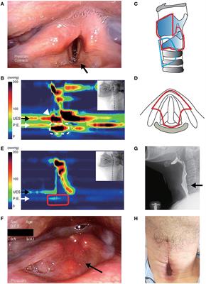 Choice of Aspiration Prevention Surgery for Patients With Neuromuscular Disorders: Report of Three Cases